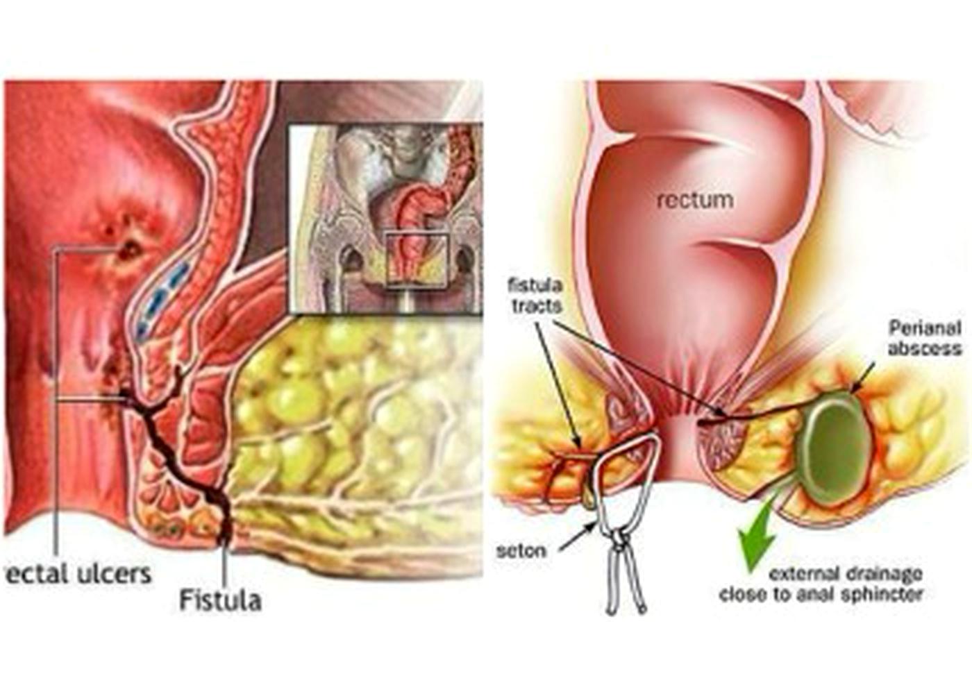 Anorectal Problems (Kshar Sutra)