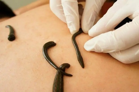 RakthaMokshana (Leech Therapy) - Authentic Ayurvedic Therapy at Vedicare